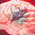 जाडोमा मस्तिष्कघातको जोखिम