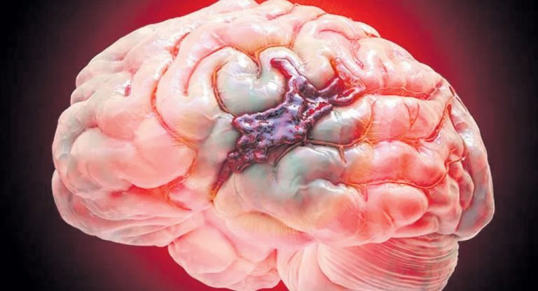 जाडोमा मस्तिष्कघातको जोखिम